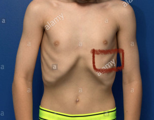 Chest Pain At Left Side