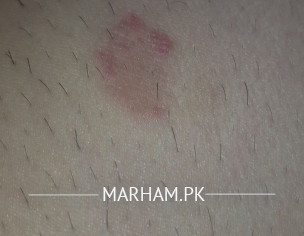 Skin Problem Coin Size Round Rashes