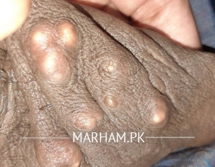 Steatocystoma Multiplex