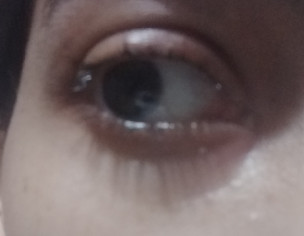 Right Watery Eye