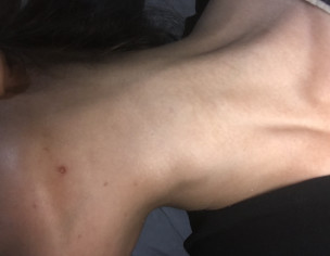 Molluscom Contagious