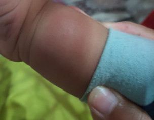 Mosquito Bite Or Something Else