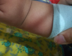 Mosquito Bite Or Something Else