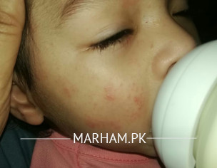 Red Marks On Face