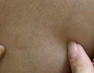 Dermatological Issue