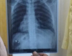 Chest Xray Indication