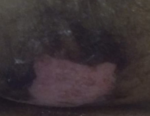 Open Wound After C-section