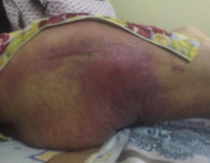 Severe (bed Sore Type Rashes)