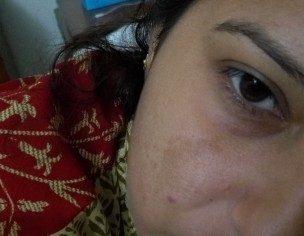 Face Skin Pigmentation