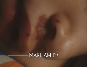 Bruise After Falling