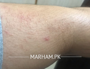 Rash Over Skin