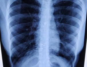 Cough Since 15-20 Days