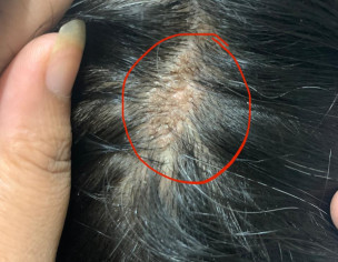 Irregular Patch On Scalp