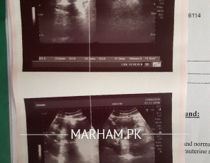 Right Ovary Enlarged