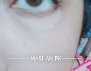 White Patch Under My Eye