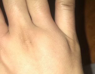 Itching All Over Body