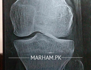 Pain In Left Knee Joint