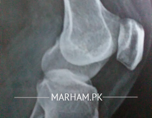 Pain In Left Knee Joint