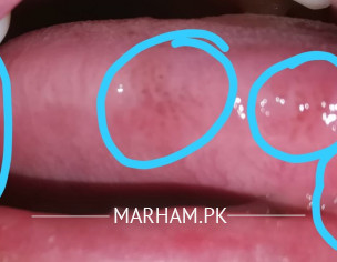 Oral Ulcers (Dermatologists)