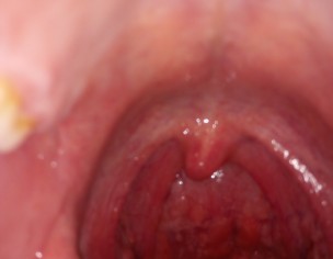 THROAT ISSUE