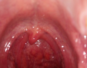 THROAT ISSUE