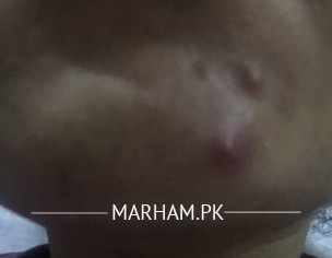Severe Acne On Chin 