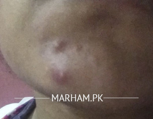 Severe Acne On Chin 