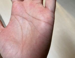 Pink Spots On Hands
