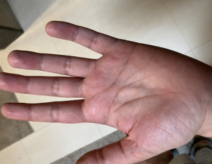 Pink Spots On Hands