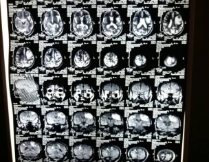 Brain Tumour/infection