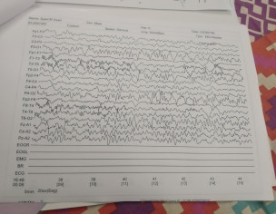 Neurology Brain Waves Pattern Issue