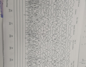 Neurology Brain Waves Pattern Issue