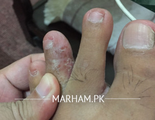 Foot Finger Infection 