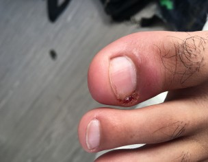 Swollen Toe