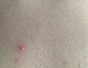 Pimple Below Neck