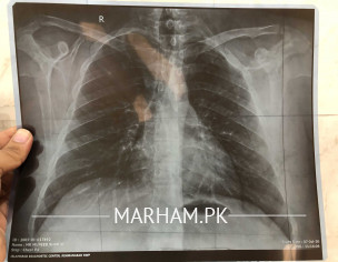 Chest Pain And Cough