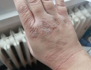 Extreme Dryness On Hands