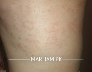 Allergy