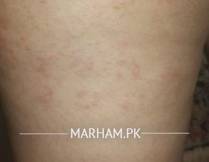 Allergy
