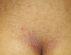 Dry And Itchy Red Patches On Back