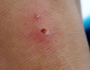 BUG Bite On Ankle