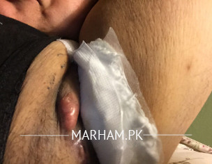 HS ( Hydradentis Supperativa ) Stage 3