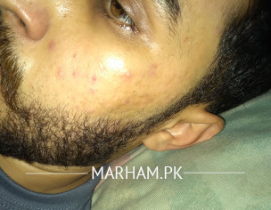 Acne In Small Intervals