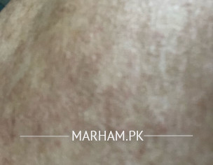 Skin Patches At Back