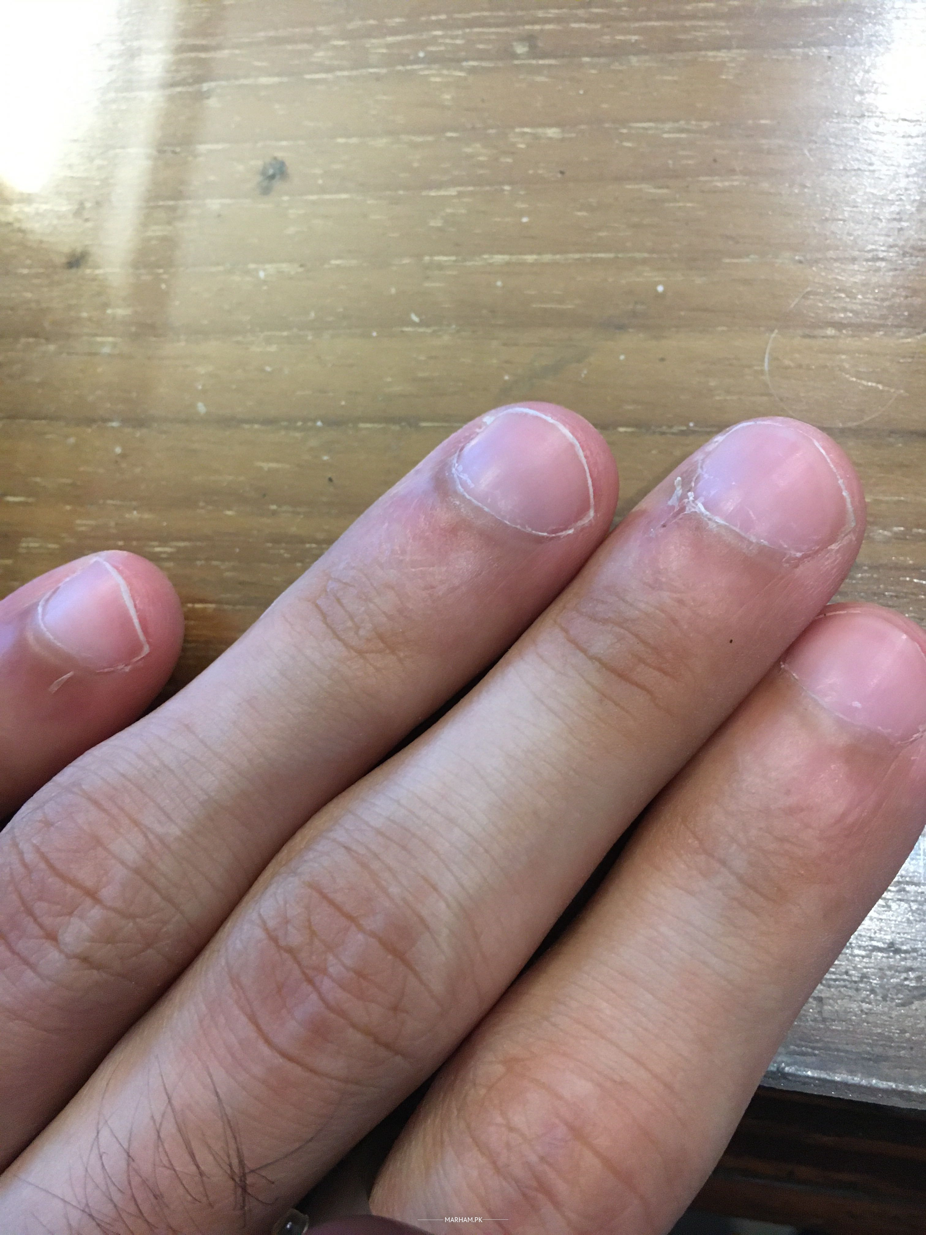 Are my “naked nails” okay? I've been wearing nail polish every single day  for about 12 years so I guess some discoloration is normal. But is this too  much? Should I be