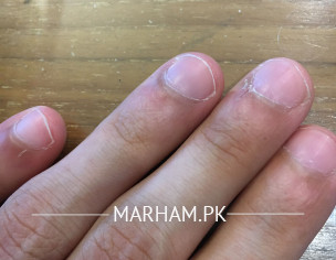 Nail Discoloration