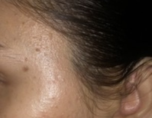 Skin Bumps On Face