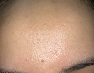 Skin Bumps On Face
