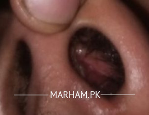 Nose Issue Nose Left Side Problem