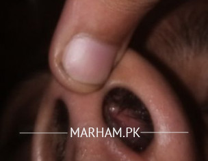 Nose Issue Nose Left Side Problem